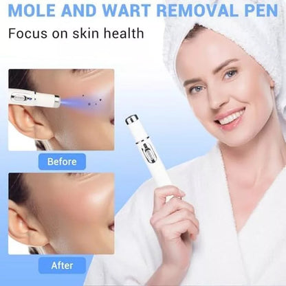 TalfMous Blue LED Light Therapy Wart Care Device