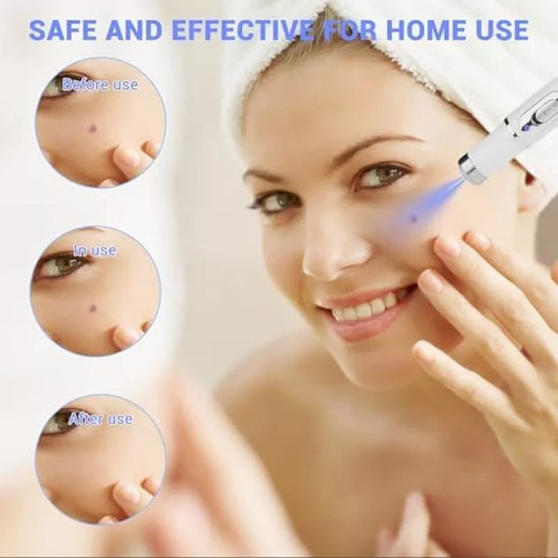 TalfMous Blue LED Light Therapy Wart Care Device