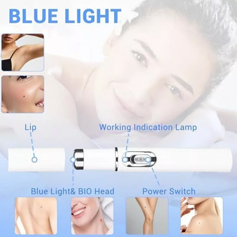 TalfMous Blue LED Light Therapy Wart Care Device